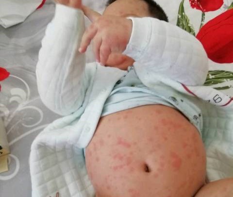 疫情期间感冒发热了怎么办,疫情期间小孩发热就诊流程