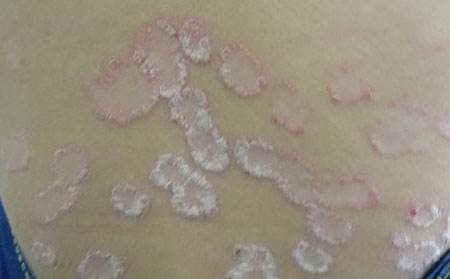 如何处理春季高发皮肤病,冬季皮肤病预防