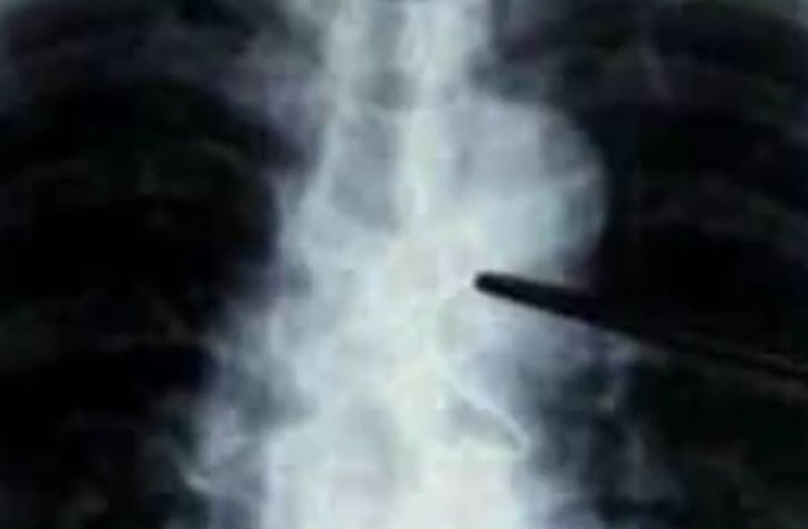 孩子误吞棒棒糖棍子反应,男童误吞2厘米钉子