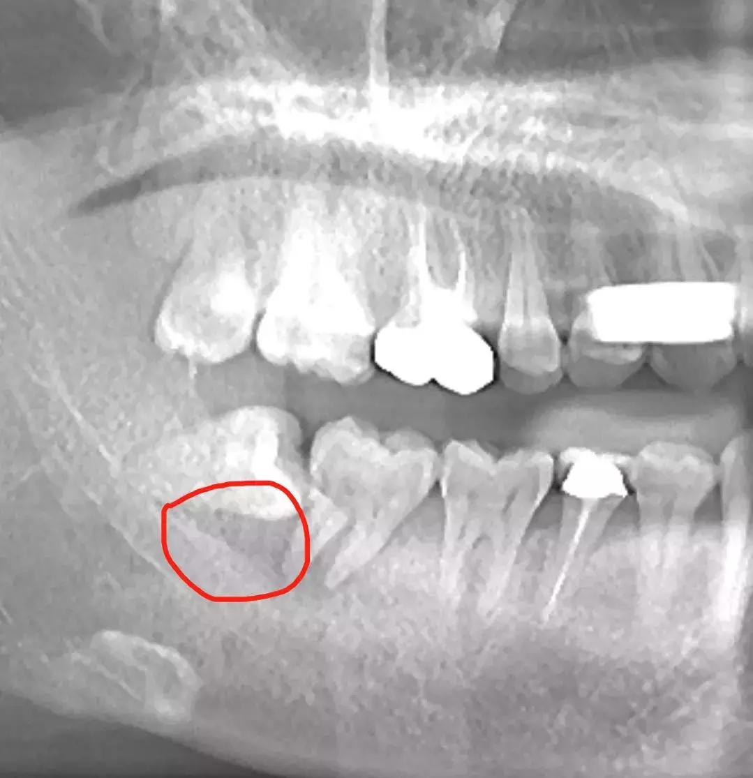 拔完牙窟窿里有食物残渣,拔完牙的窟窿进食物了怎么办