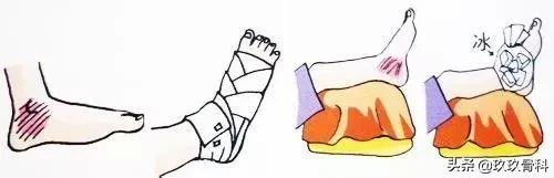 踝关节受伤小腿肌肉萎缩怎么锻炼,踝关节受伤后怎么锻炼