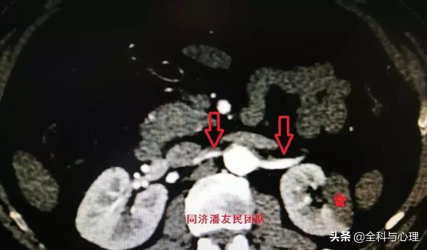 诊断主动脉夹层，千万别犯这种错误！