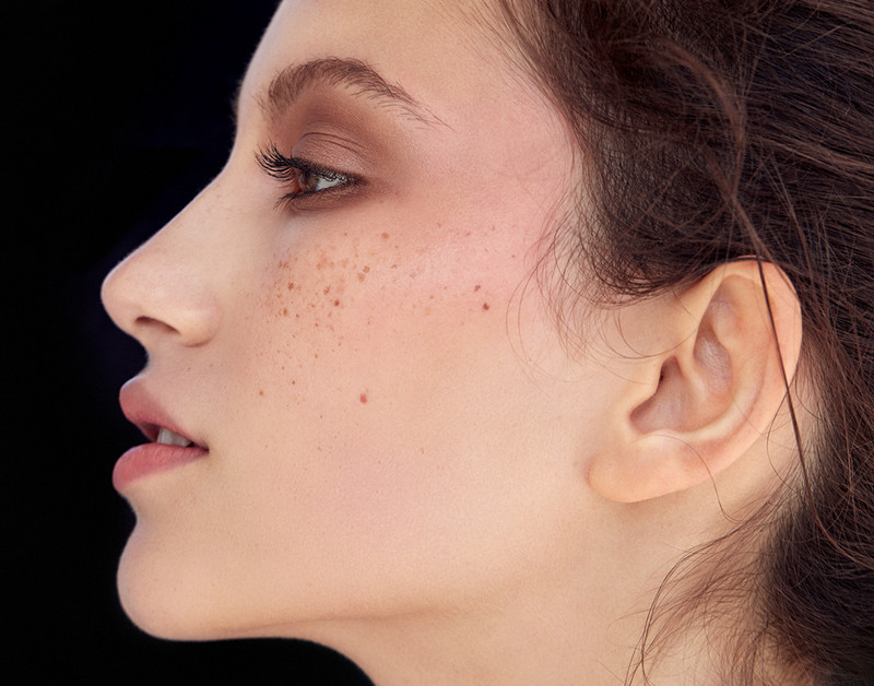 雀斑日晒后明显,紫外线晒出来的雀斑