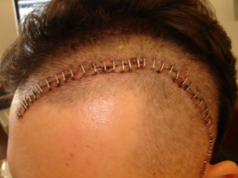 史上最震撼的抗癌经历,记录一下自己的抗癌经历