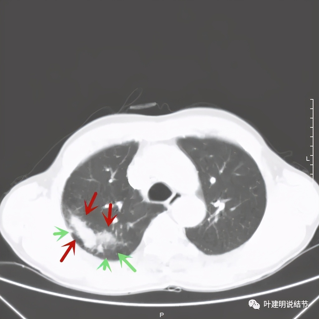 肺占位病理活检无病变,肺部占位穿刺病理说不确定性质