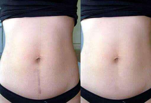 产后修复原来有这么多疑问,产后修复你了解多少