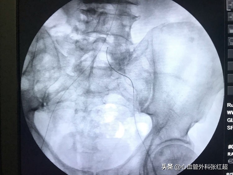 外周血管治疗图,外周血管疾病怎么治