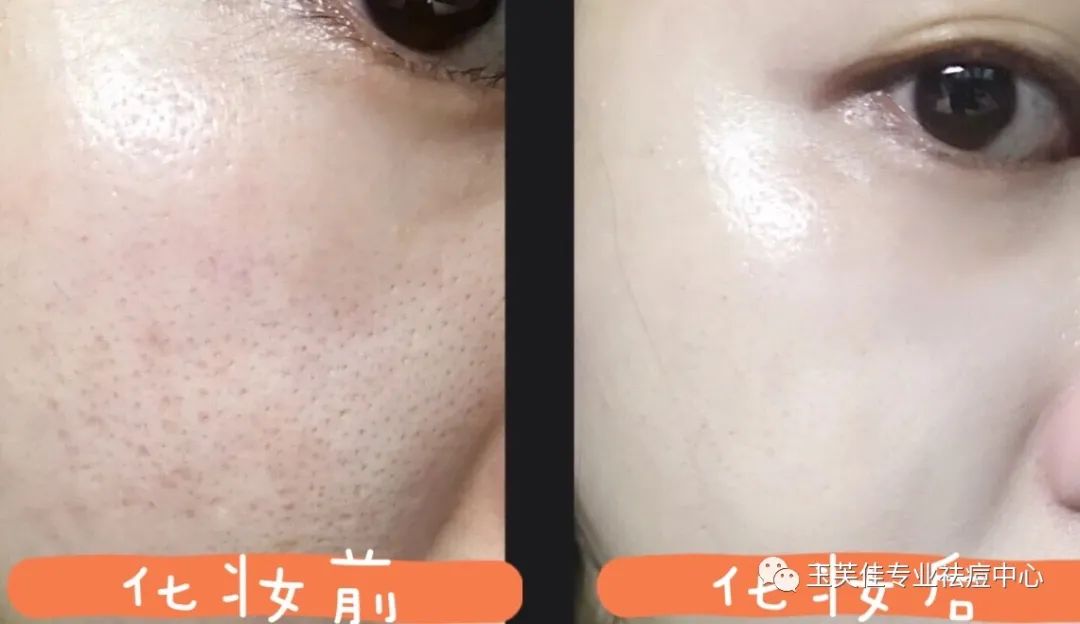 痘痘肌化妆教程用什么颜色遮瑕,痘痘肌化妆教程初学者淡妆