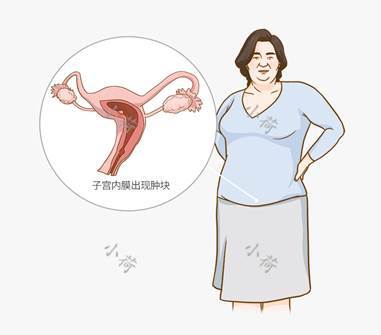 绝经17年出现阴道出血，69岁患者确诊子宫内膜癌