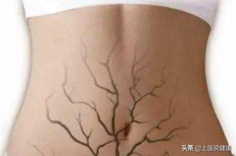 身体上出现的青筋是怎么回事,身体上的青筋明显是怎么回事