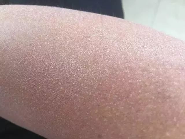 手脚干裂皮肤又厚又痒怎么办,冬天手脚干裂起皮怎么治疗