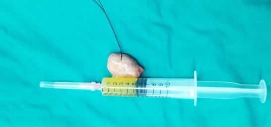 膝关节外侧肿胀且反复发作,神秘原因导致单侧膝关节反复肿胀