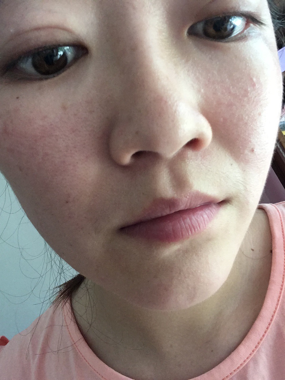 敏感肌长粉刺闭口怎么办,敏感肌发红发痒闭口怎么办