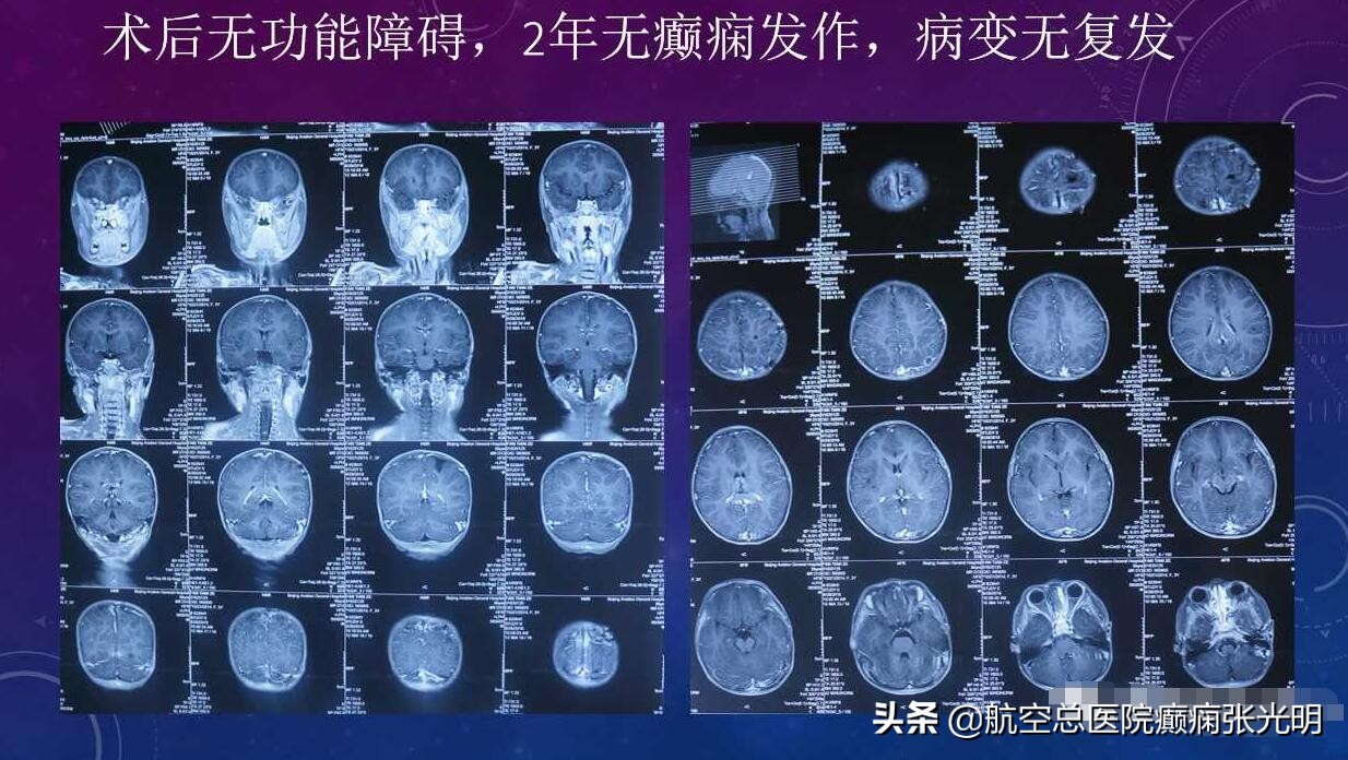 张光明左颞叶癫痫手术成功率,张光明谈治疗癫痫的方法有哪些