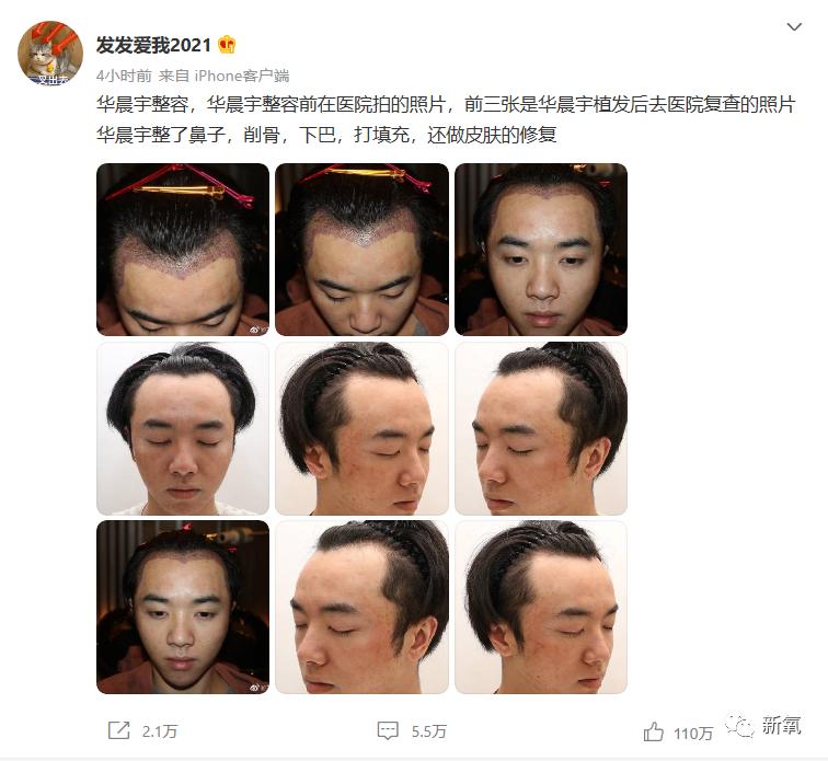华晨宇整前整后对比,华晨宇最近又整脸了么