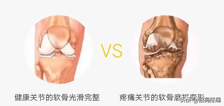 老年人膝盖变形疼痛怎么办,老年人膝关节痛严重变形怎么治疗