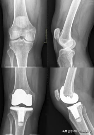 骨刺吃什么药可以抑制骨刺的生长,长骨刺独家药方喝四天就能止痛