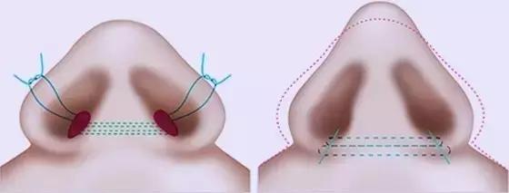 隆鼻能坚持到老吗,隆鼻的潜规则有哪些