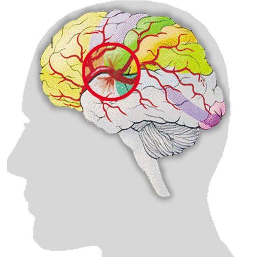 脑梗的人血压最低保持多少,脑梗的病人血压降到115至72正常吗