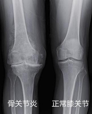膝盖有骨刺和关节炎怎么治疗最好,膝关节长骨刺一冷就疼怎么治疗