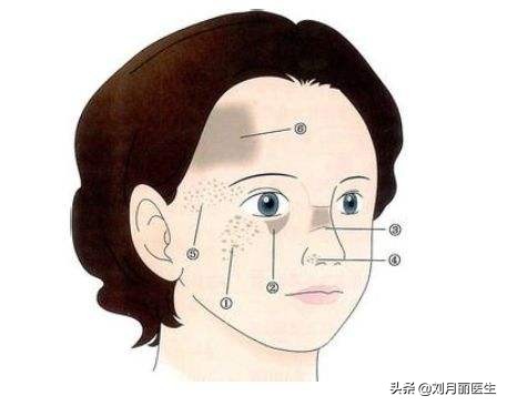 太田痣黑色胎记去除的案例,激光治疗太田痣黑色素怎么消除