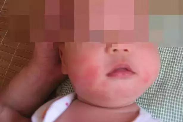 怀孕湿疹反反复复如何彻底根除,孕妇湿疹怎么治好得快