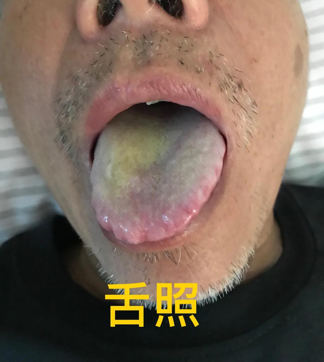 典型先兆性偏头痛怎么治,偏头痛左侧痛