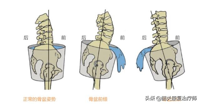什么是下交叉综合征？下交叉综合症的解剖分析与纠正训练