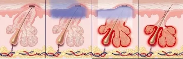 祛痘激光手术能彻底把痘痘去除吗,脸上痘痘太多做什么医美不伤皮肤