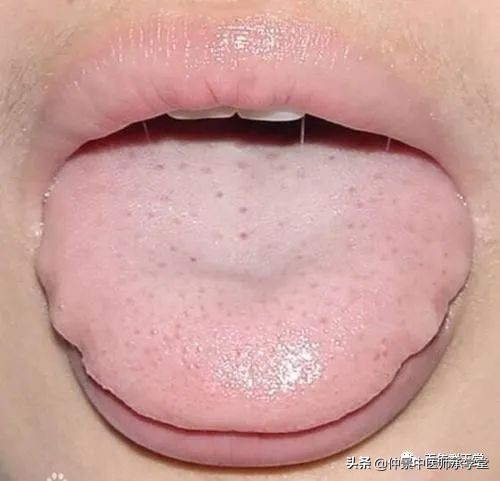 湿气重会引起牛皮癣吗,湿气重皮肤病与银屑病的区别