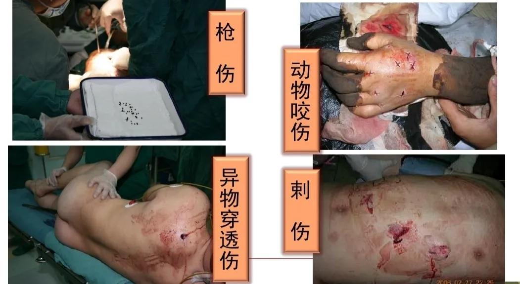 破伤风其实没那么可怕,科普关于破伤风的一些事儿