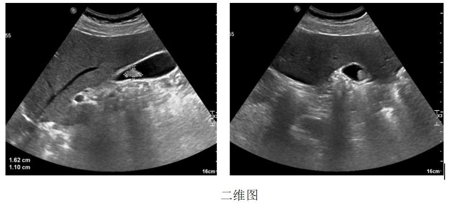 胆囊息肉消融保胆有效吗,胆囊息肉消融保胆有用吗
