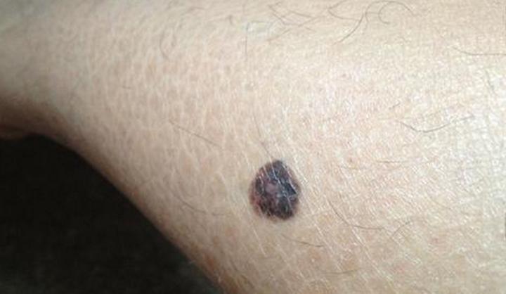 街上点痣10元可靠吗,路边点痣真的可靠吗