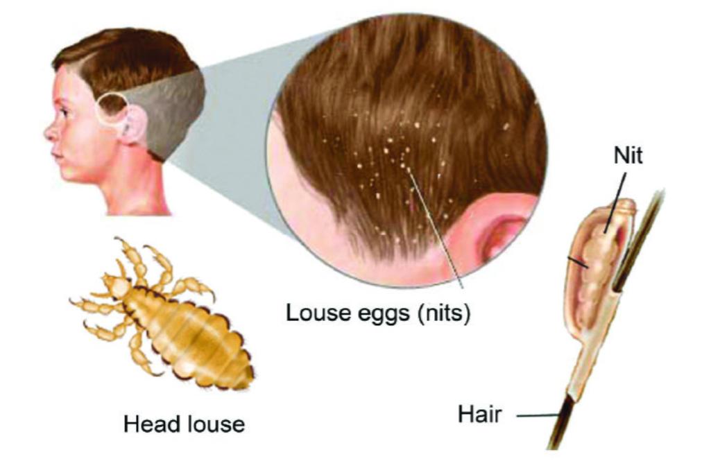30年前人人身上都有的虱子,30年前人人都有虱子为啥现在消失