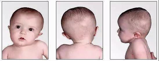 儿童神经系统引起的斜颈怎么治疗,哪个医院擅长治疗儿童斜颈