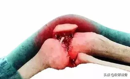 类风湿性关节炎手掌长有骨刺咋办,关节长骨刺一定是创伤性关节炎吗