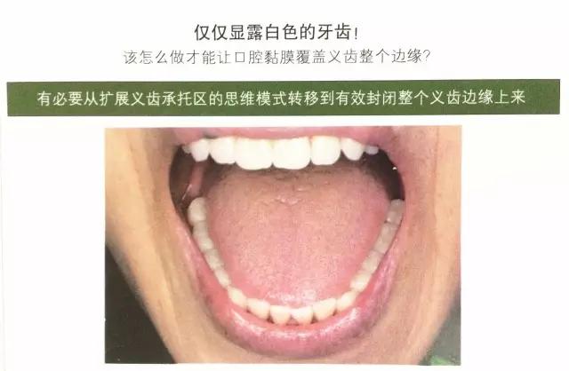 传统义齿和吸附性义齿区别,吸附性义齿和传统义齿区别