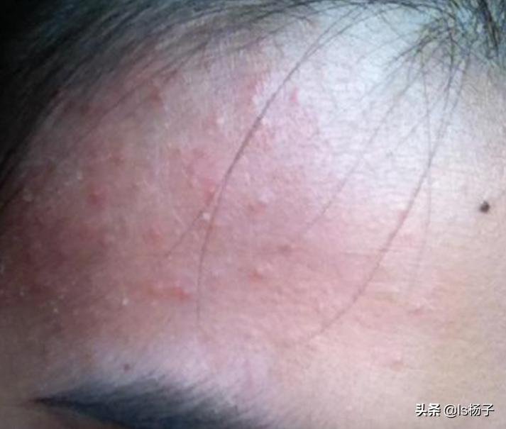 7岁孩子脸上起小米粒疙瘩有白尖,脸上长了好多小白尖的痘痘