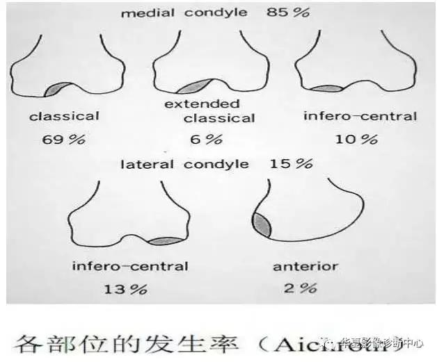 膝关节痛警惕四种病,科普膝关节疼痛影响到的22种疾病