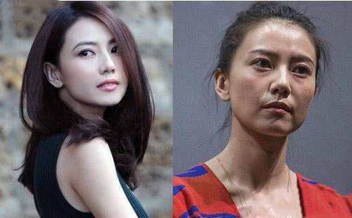 瘦脸针一年后出现后遗症如何补救,瘦脸针的后遗症失败案例图片