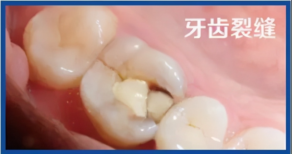 门牙根管治疗后没做牙冠牙齿劈裂,牙齿残冠一定要做根管治疗吗