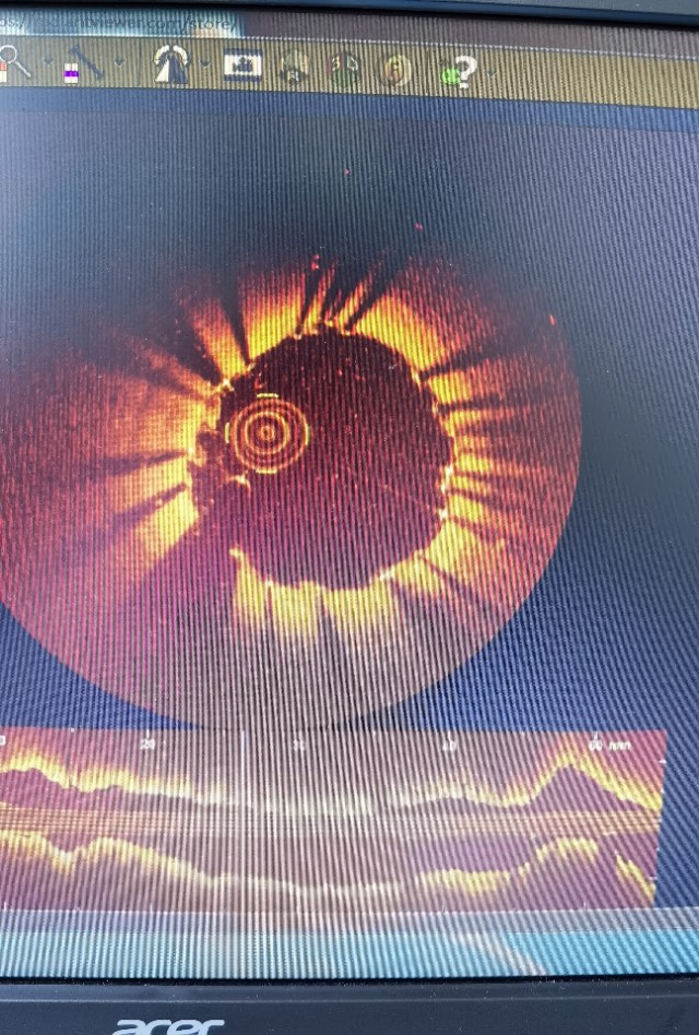 信阳市中心医院心脏射频消融手术,信阳中心医院心血管科室怎样