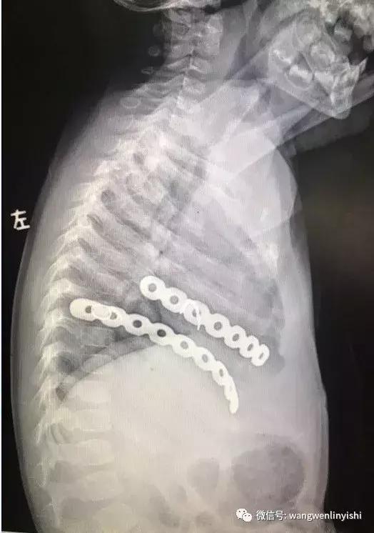 先心病开胸手术胸骨用什么缝合,心脏手术后胸骨后脓肿怎么处理