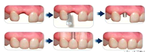 种植牙烤瓷牙假牙如何选择,活动假牙烤瓷牙种植牙到底怎么选
