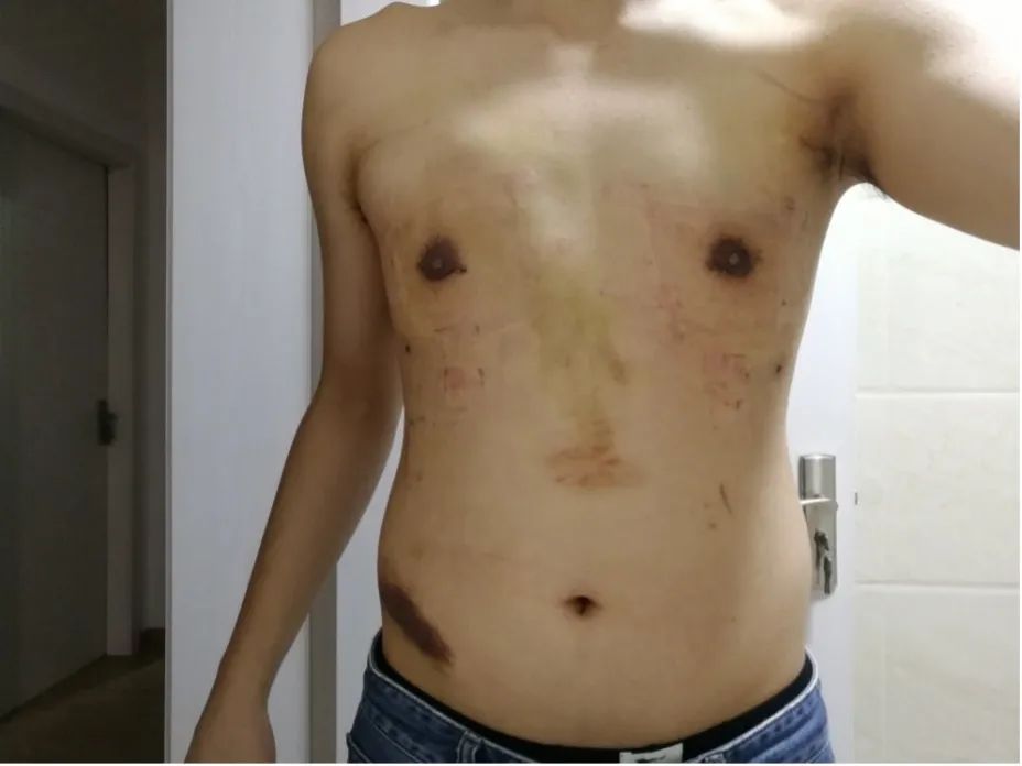 两个乳房发育不一致正常吗,乳房发育后才长腋毛正常吗