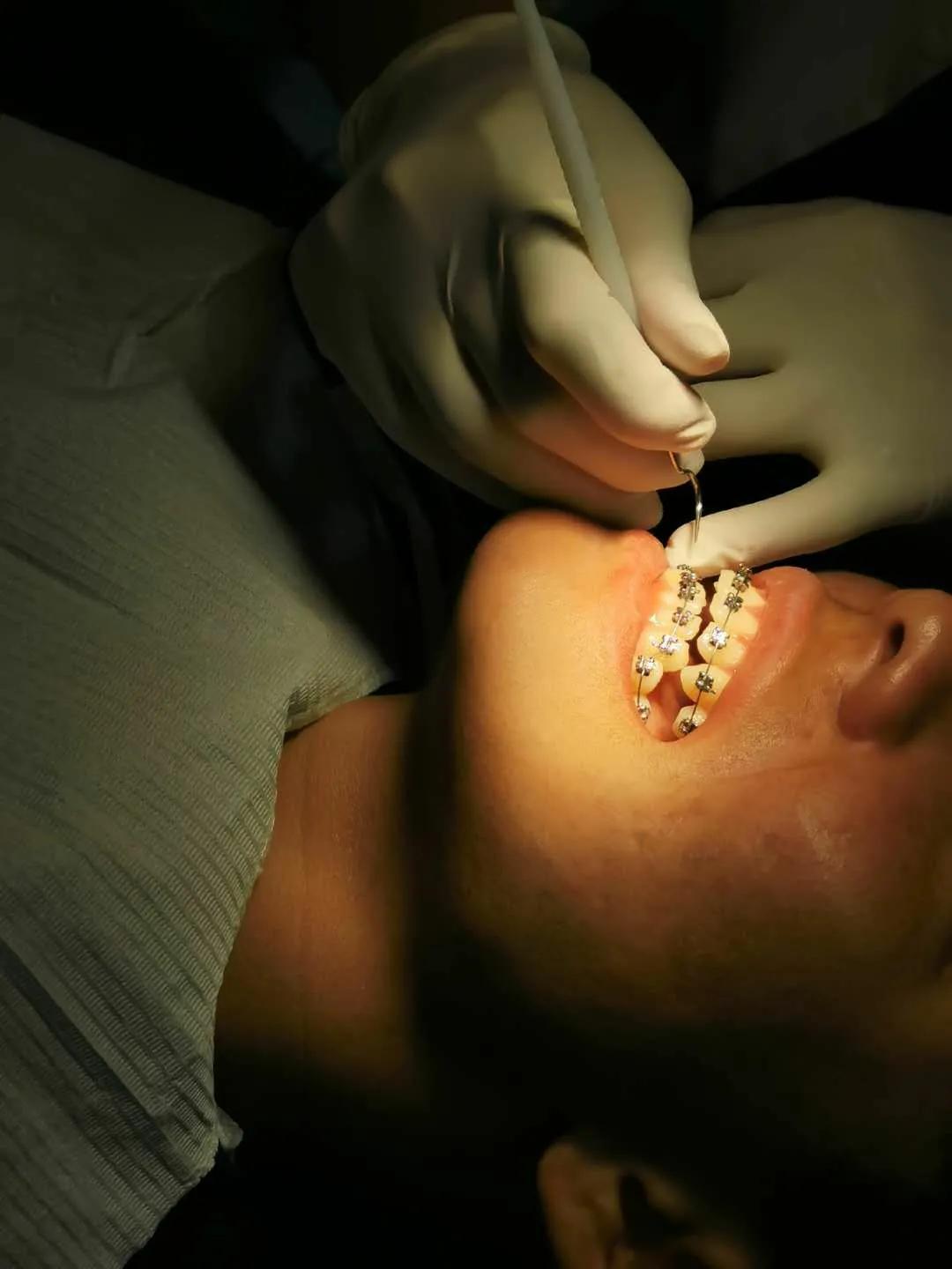 戴了牙套会更好看吗,戴了牙套有后遗症吗