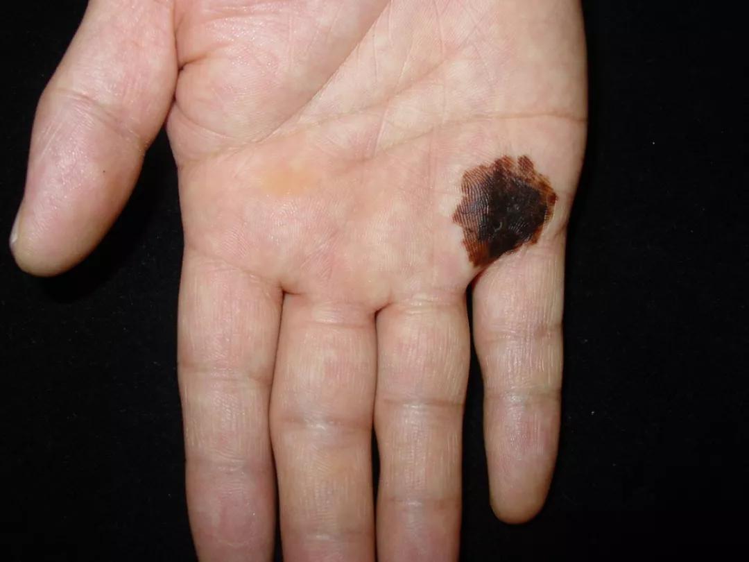 痣用点么,痣能点么