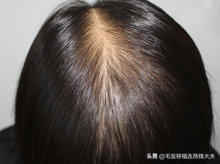 米诺地尔治疗男性脱发有效果吗,米诺地尔治疗脱发