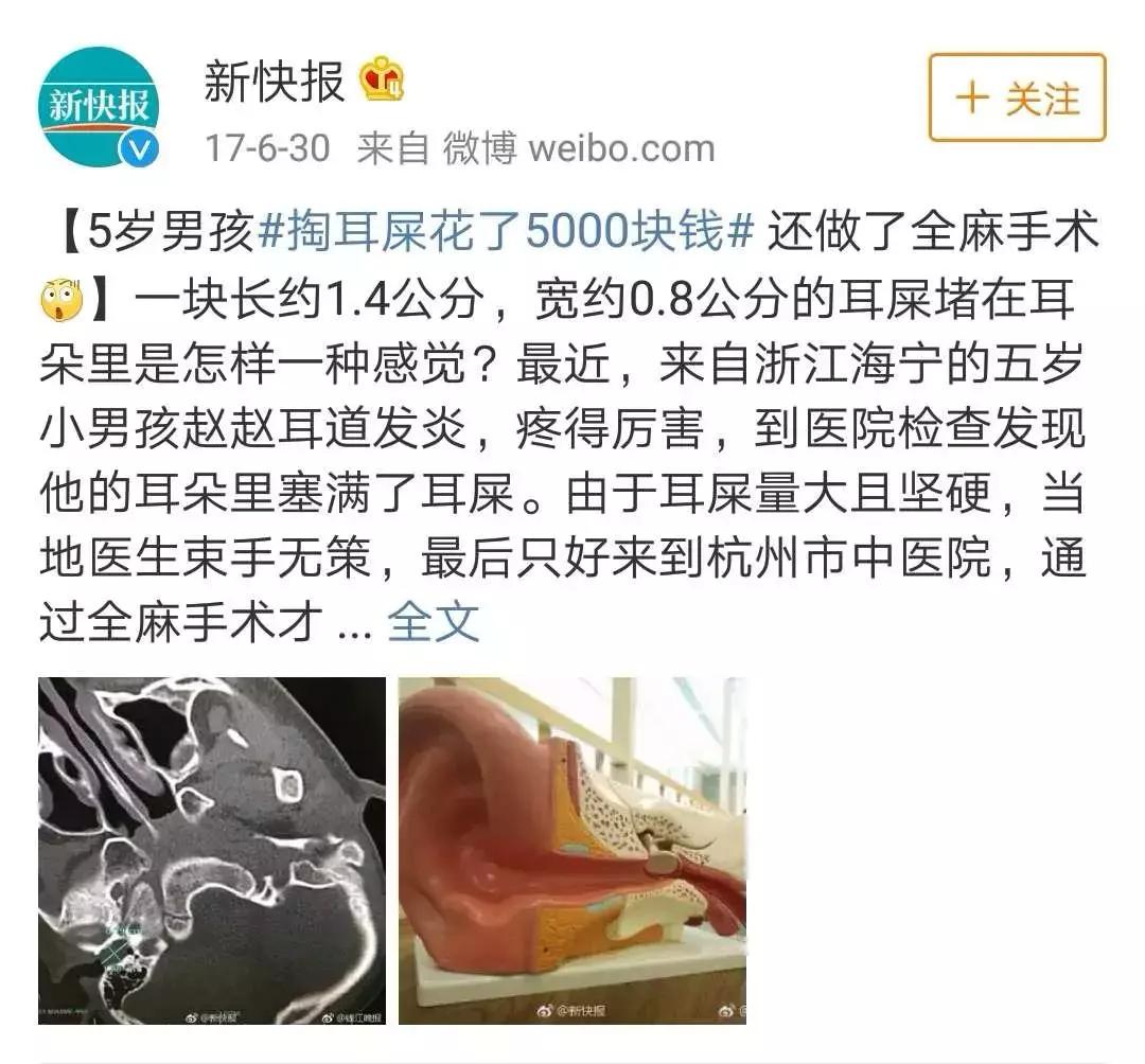 医院怎么给小朋友清理耳屎,孩子多久需要去一次医院清理耳屎