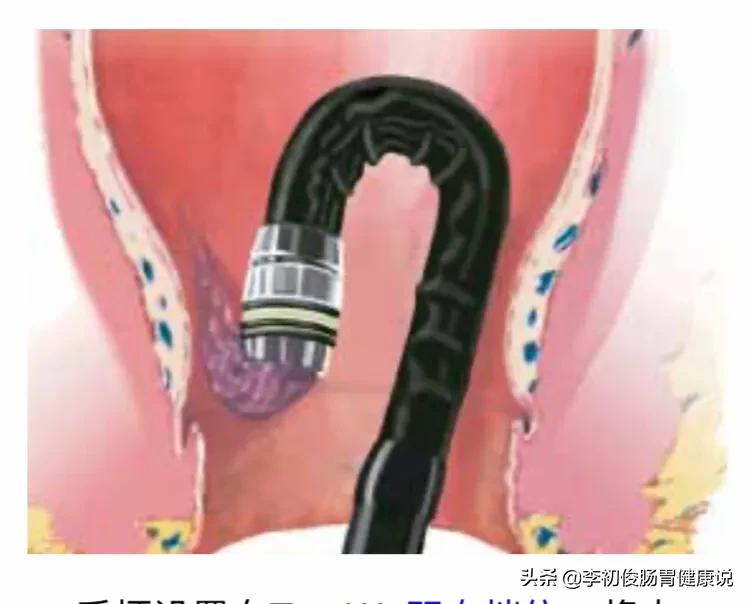 一次无痛胃肠镜一共需要多久,一次做完胃肠镜